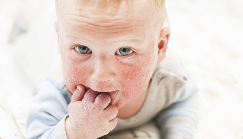 Alergia u dzieci, na co zwrócić uwagę?
